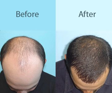 best hair regrowth treatment in delhi