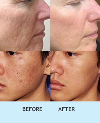 microneedling for acne scars, Microneedling for acne scar in delhi, Microneedling therapy india, Microneedling for acne scar in rajouri garden, Microneedling therapy in india