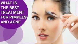 What is The Best Treatment For Pimples And Acne - Look Young Clinic