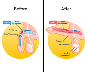 PRP Therapy for Erectile Dysfunction