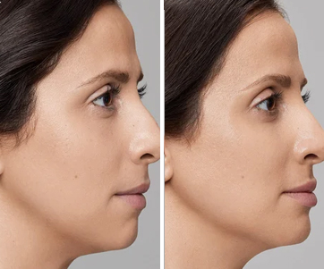 Jawline Filler Treatment