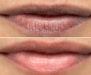 Lip Filler Treatment