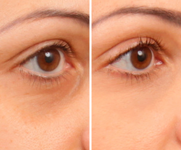 Under Eye Filler Treatment 